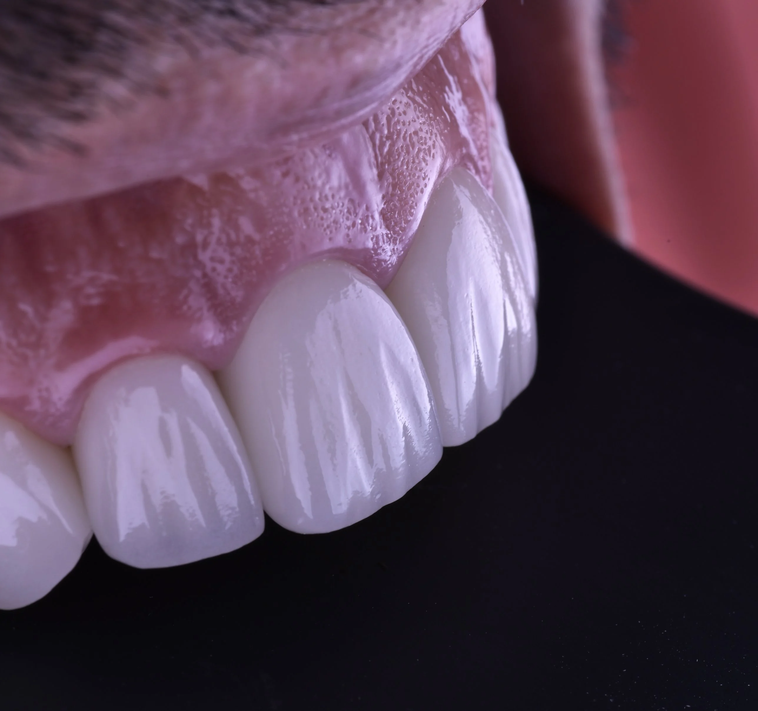 Close-up of ceramic veneers fabricated by Dr. Ravi Khubani Mirvani, with the translucency and texture of natural teeth