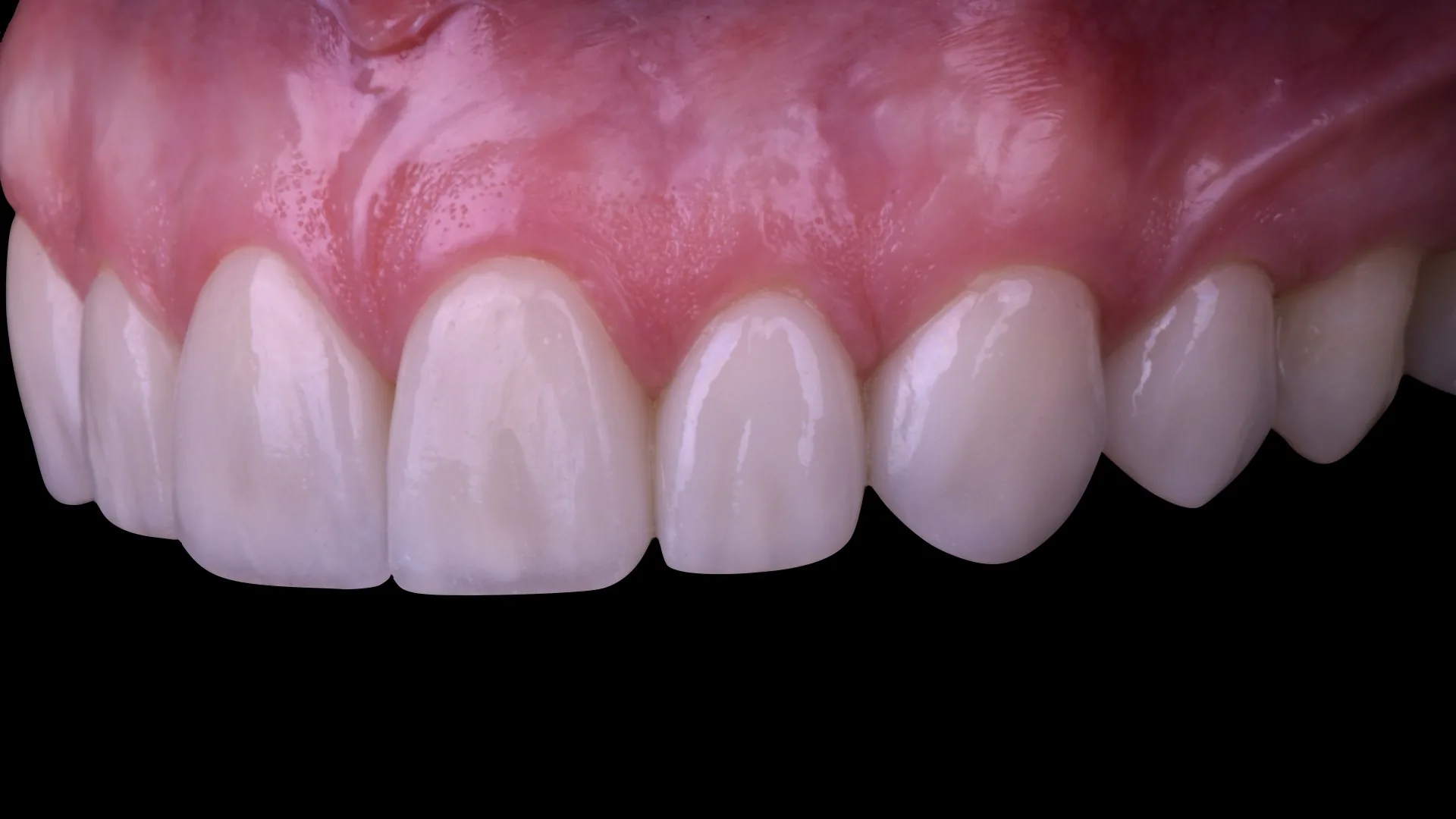 Primer plano de carillas cerámicas IPS e.max instaladas: translucidez del borde, textura y encía sana