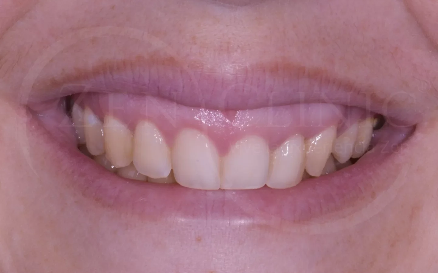 Antes: Diseño de sonrisa con carillas cerámicas
