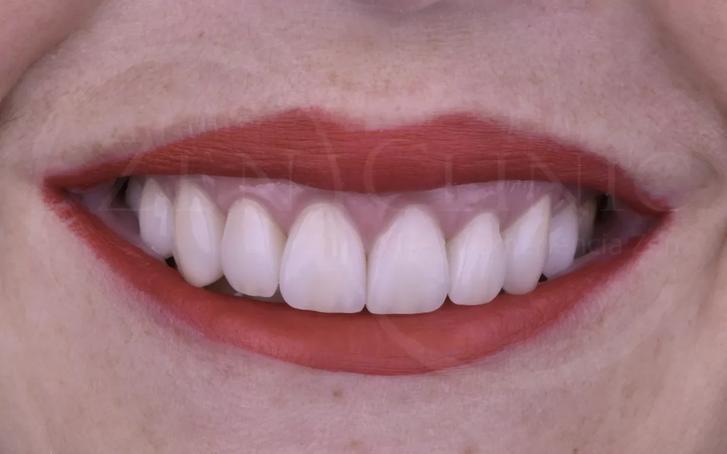Después: Diseño de sonrisa con carillas cerámicas
