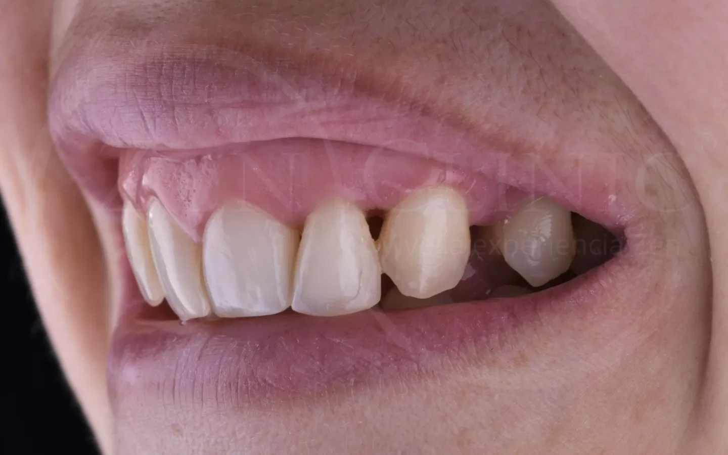 Antes: Diseño de sonrisa con carillas cerámicas