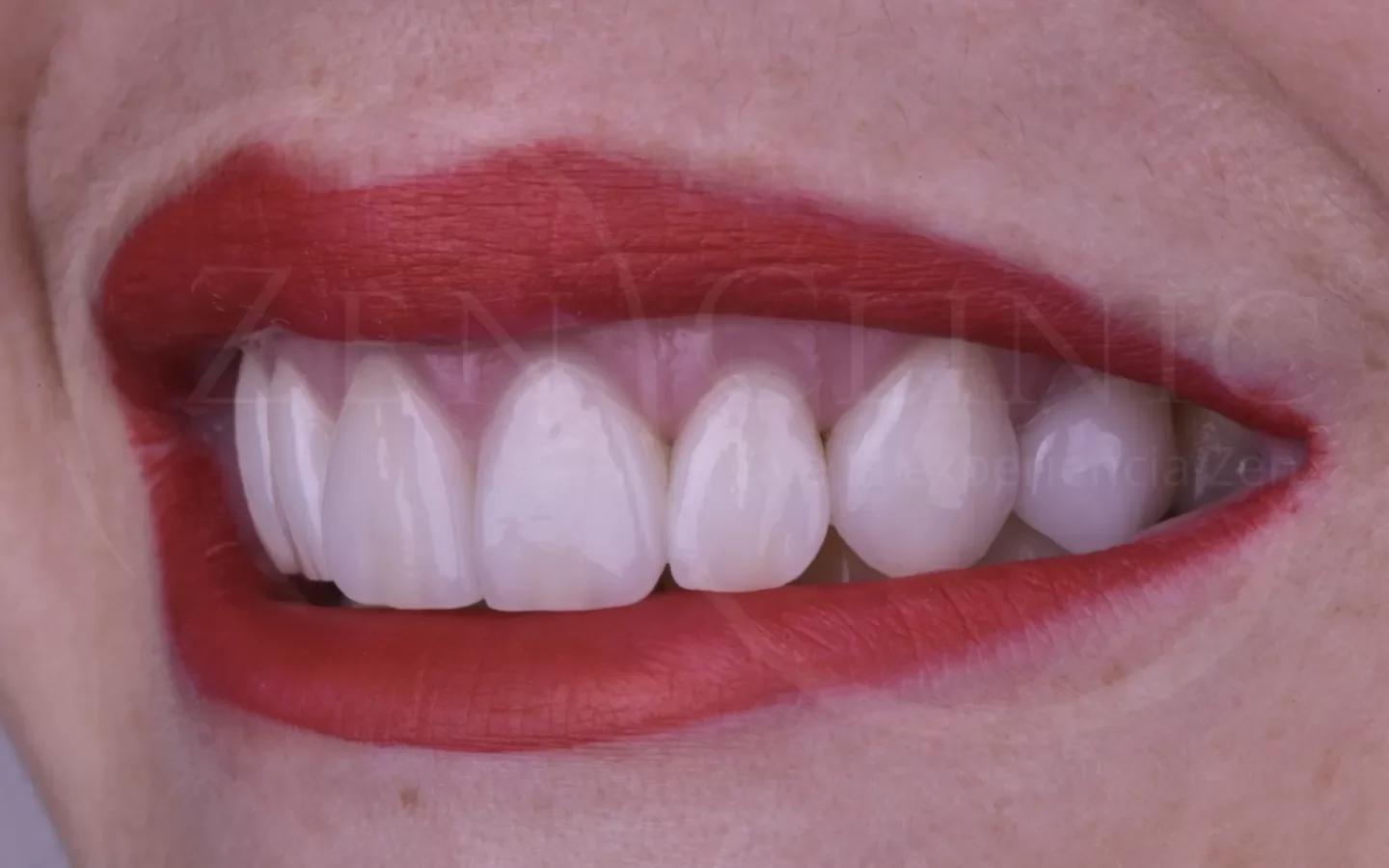 Después: Diseño de sonrisa con carillas cerámicas