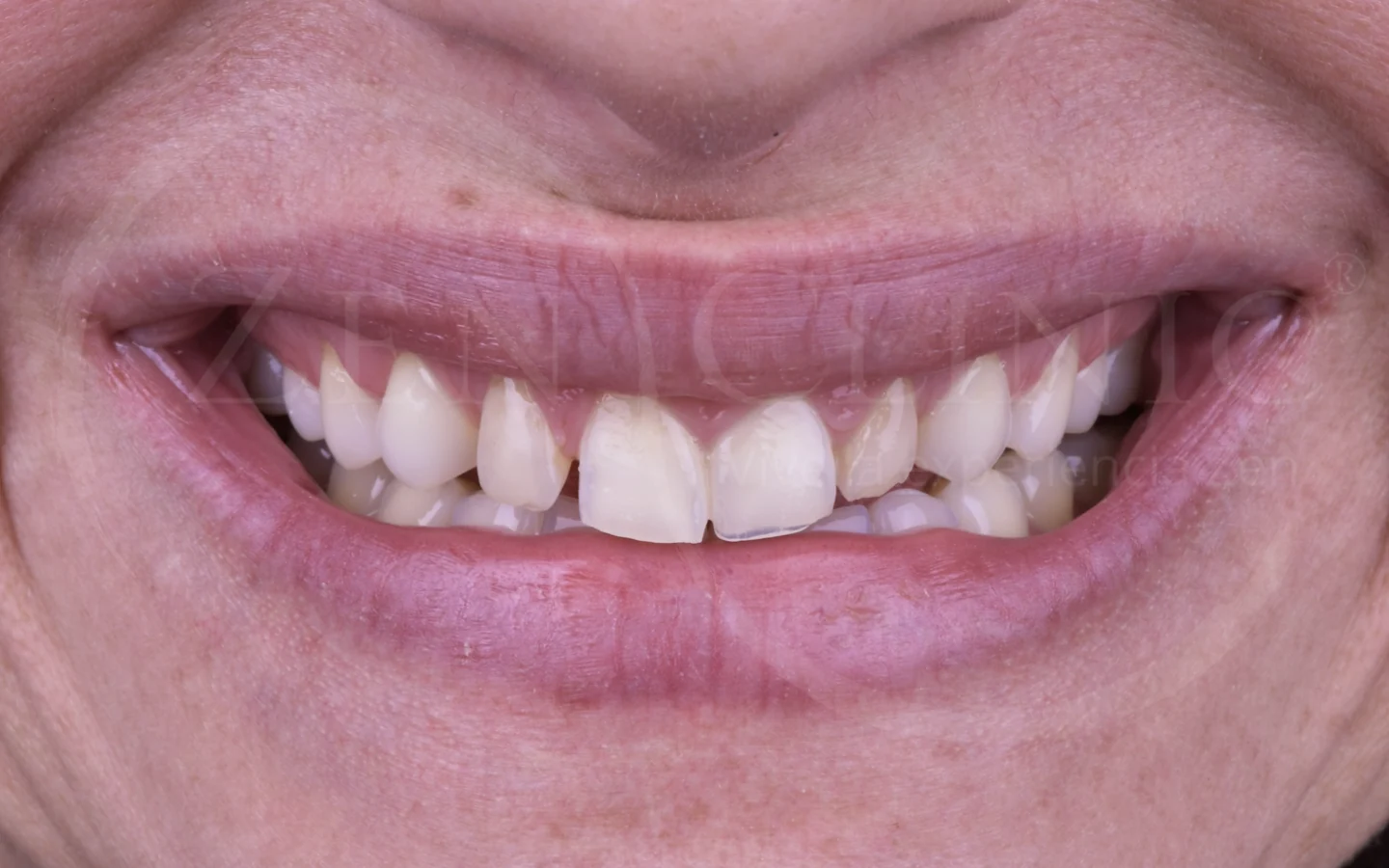 Antes: Diseño de sonrisa con carillas cerámicas