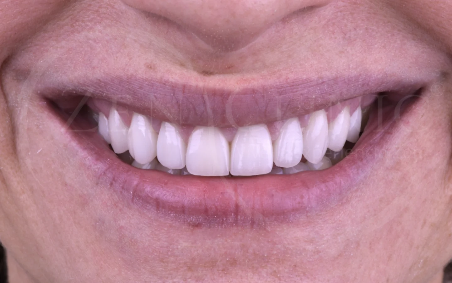 Después: Diseño de sonrisa con carillas cerámicas
