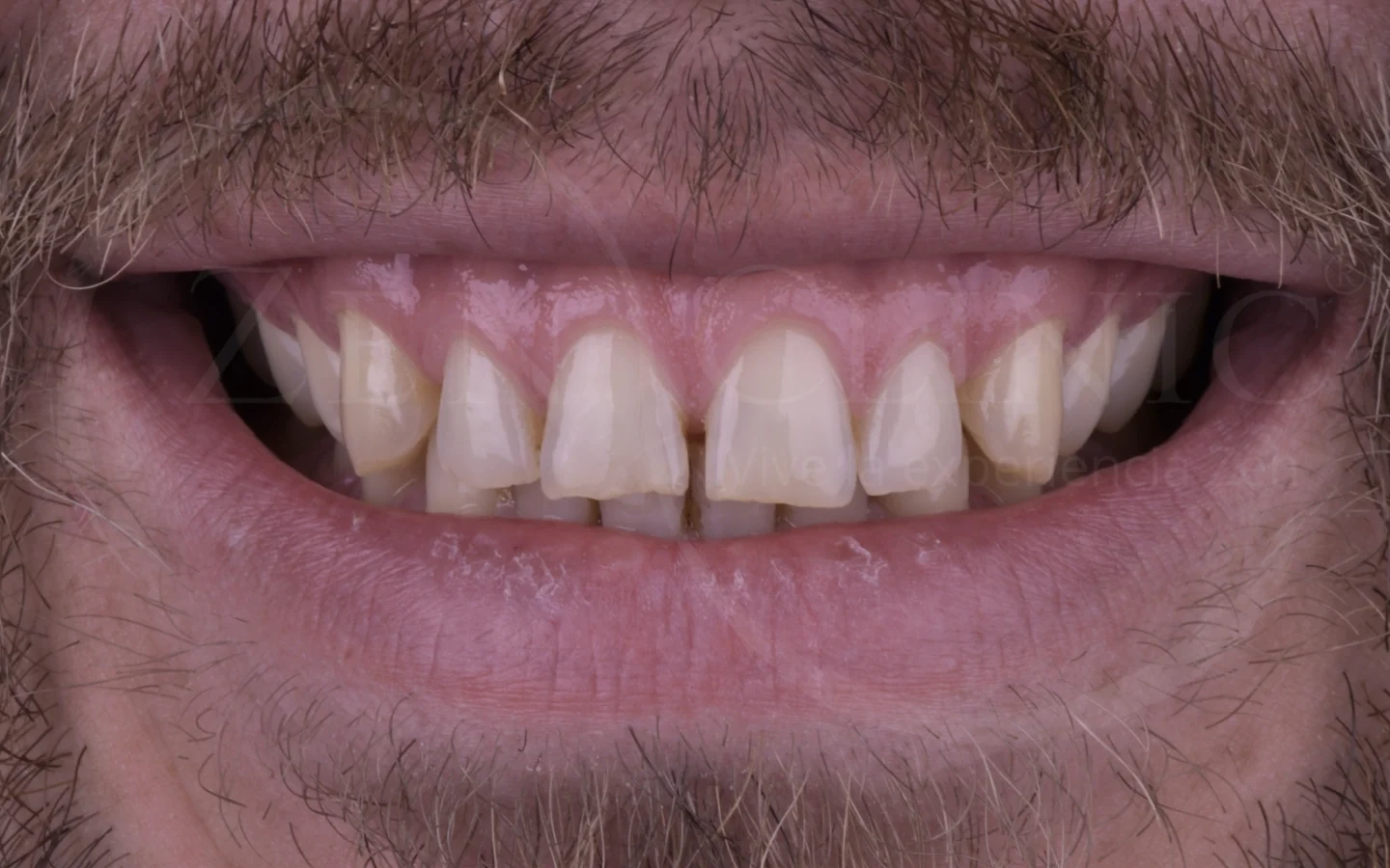 Antes: Diseño de sonrisa con carillas cerámicas