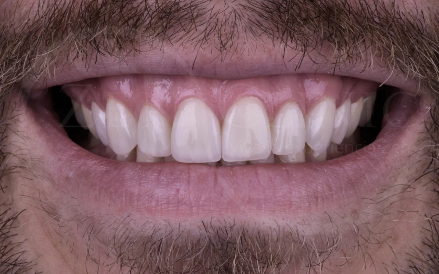 Después: Diseño de sonrisa con carillas cerámicas