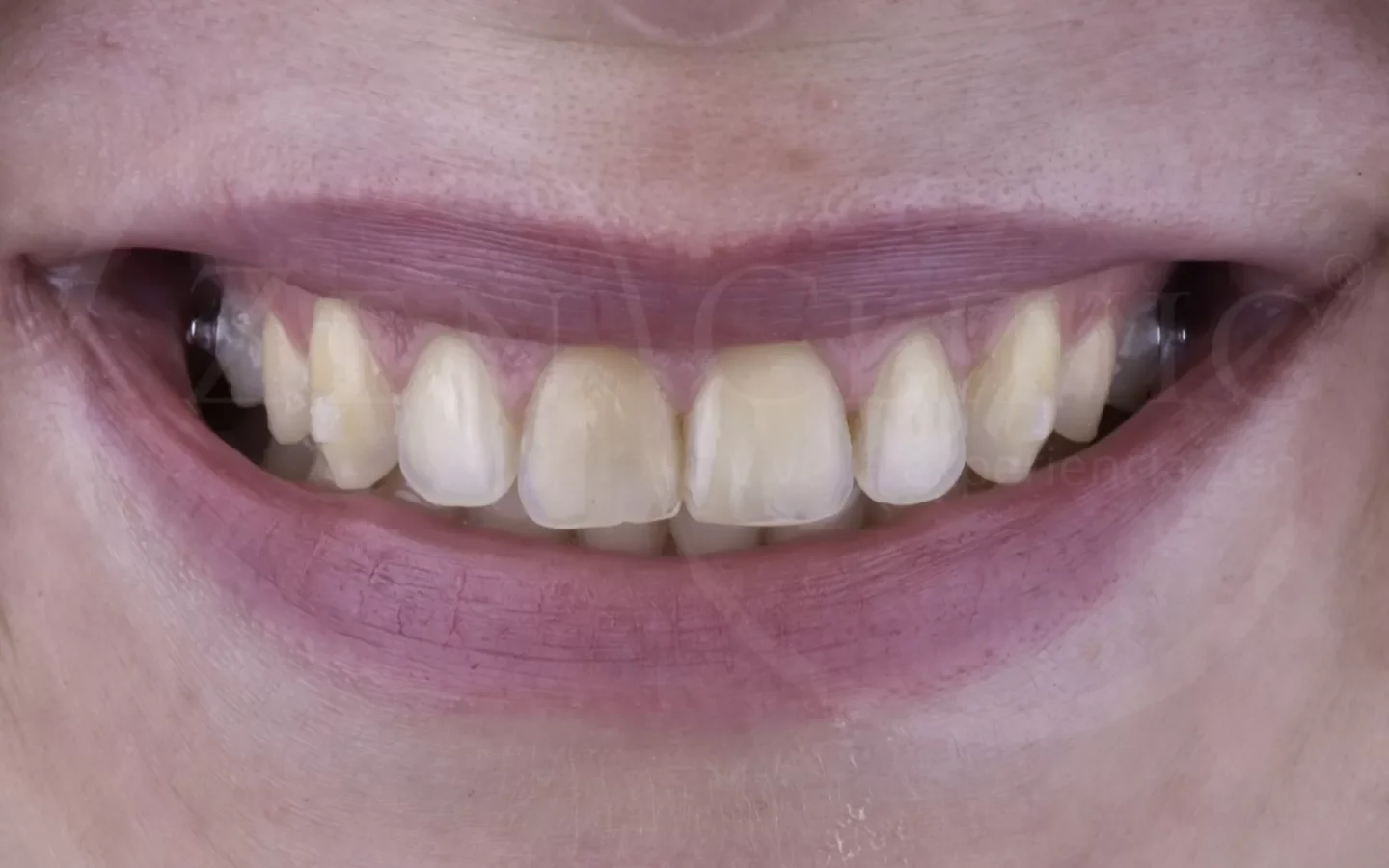 Antes: Diseño de sonrisa con carillas cerámicas