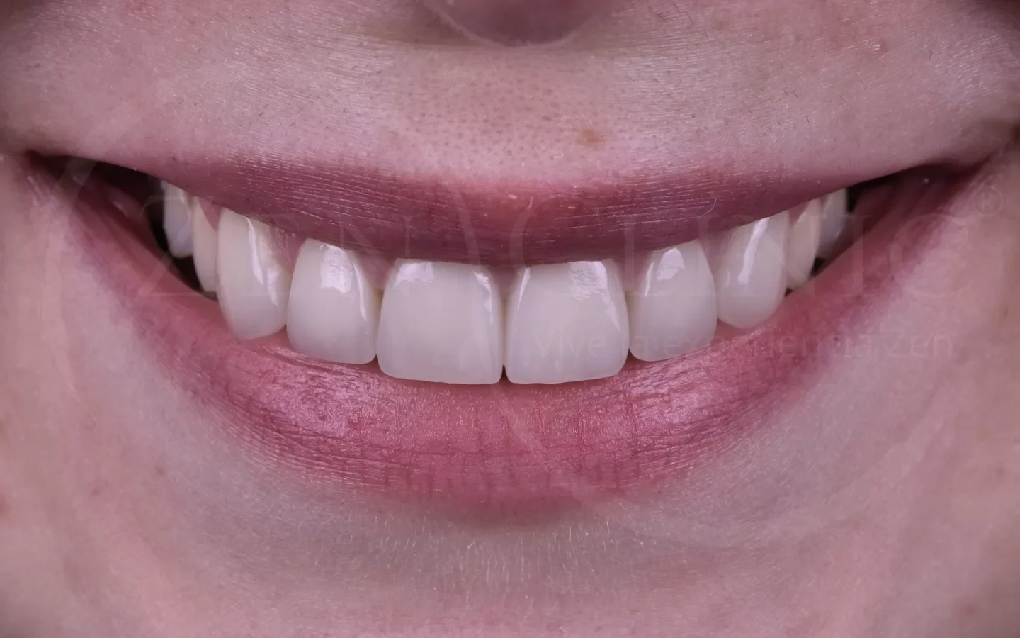 Después: Diseño de sonrisa con carillas cerámicas