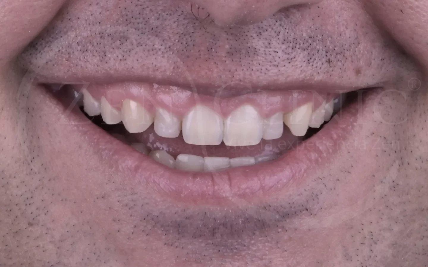 Antes: Diseño de sonrisa con carillas cerámicas