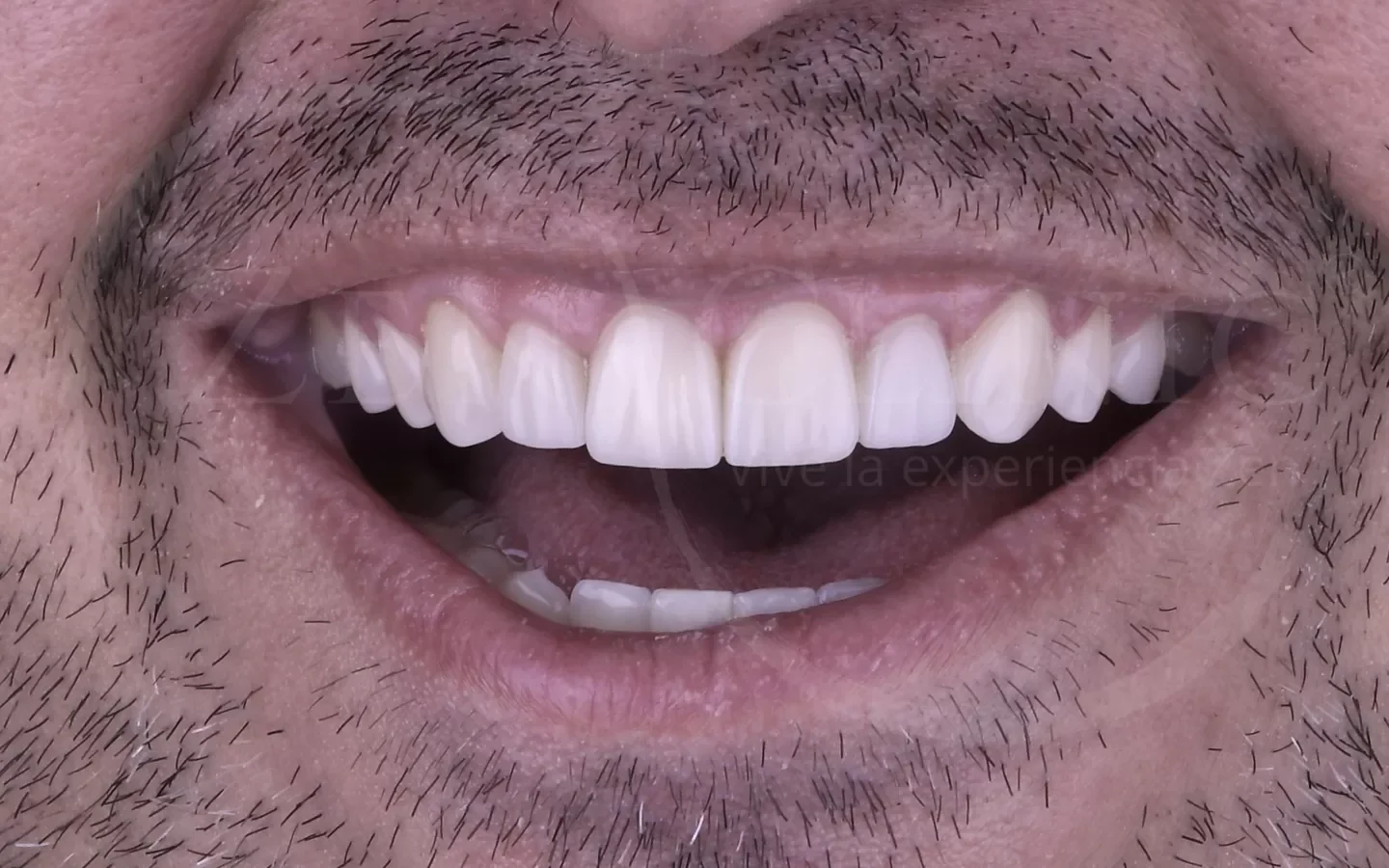 Después: Diseño de sonrisa con carillas cerámicas