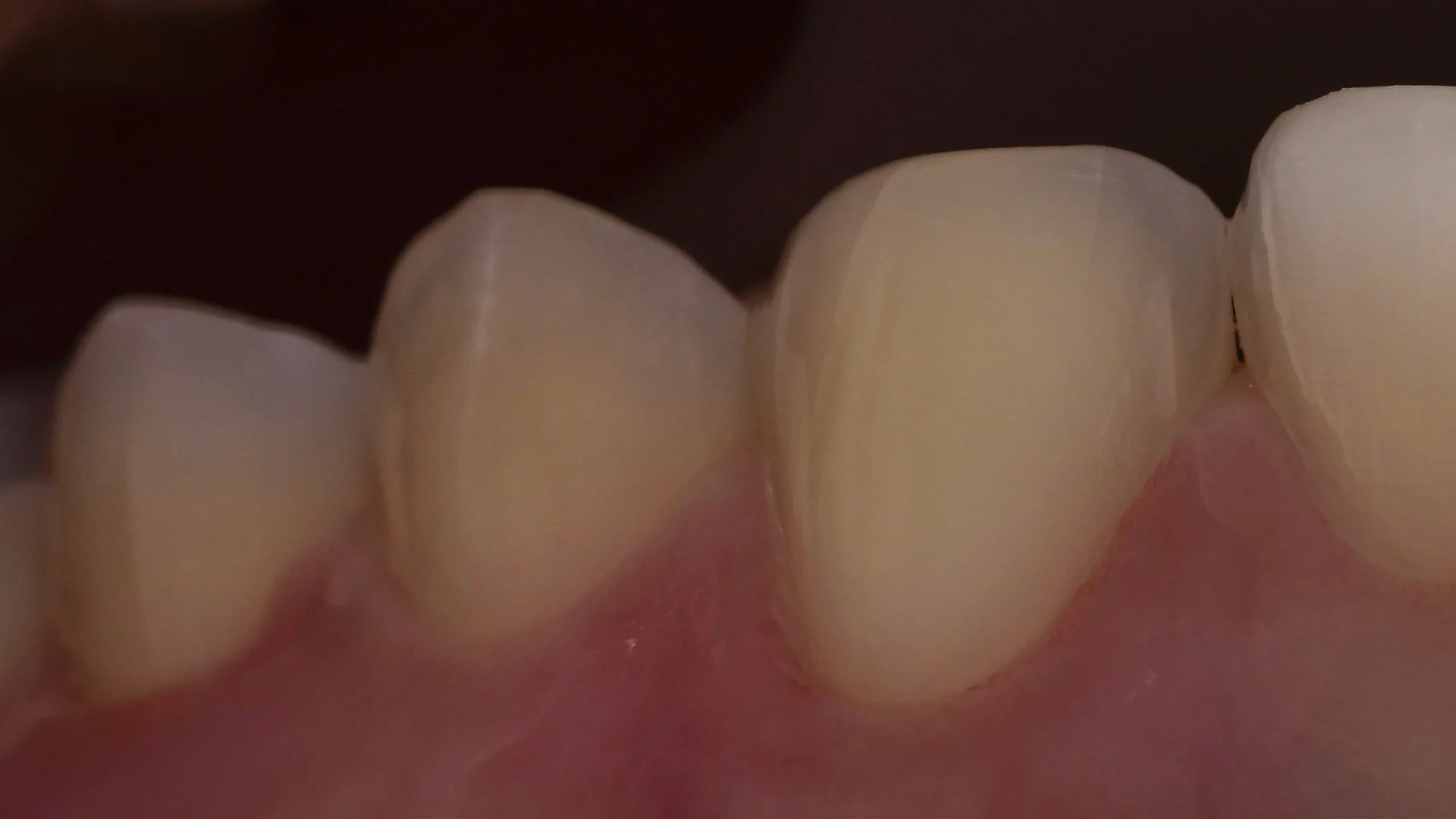 Primer plano de dientes preparados con protocolo mínimamente invasivo por el Dr. Ravi Khubani Mirvani: el esmalte se conserva casi por completo