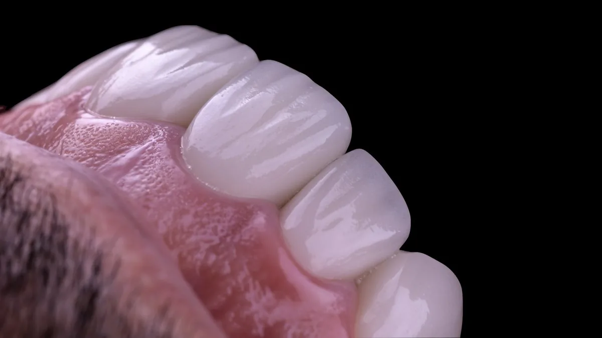 Vista oblicua de restauraciones cerámicas en los dientes anteriores superiores, caso de rehabilitación oral del Dr. Ravi Khubani Mirvani en Zenclinic Dental